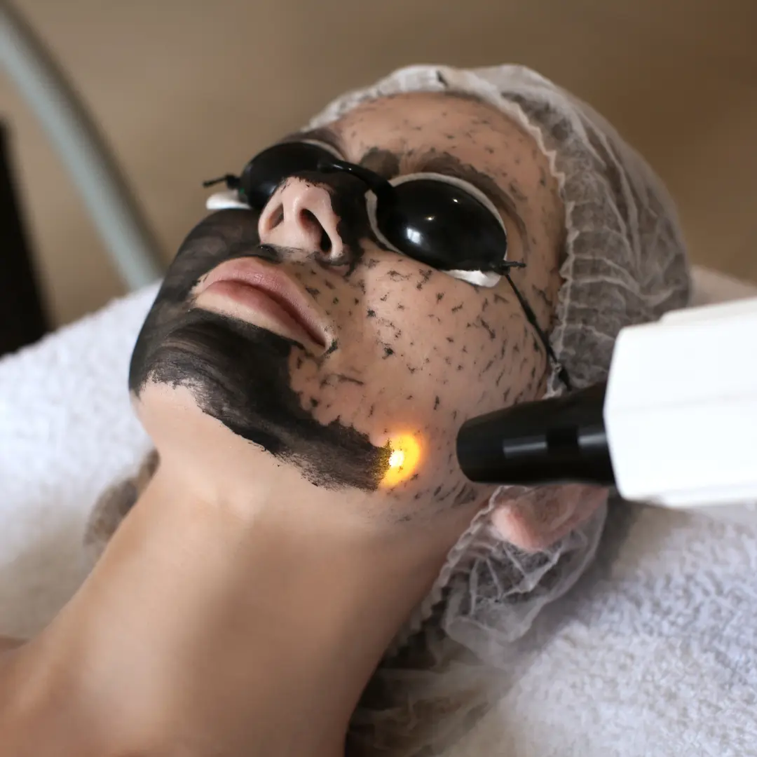 Carbon Peel Cabinet esthético-médical : carbon peel avec le Dr. Boukobza