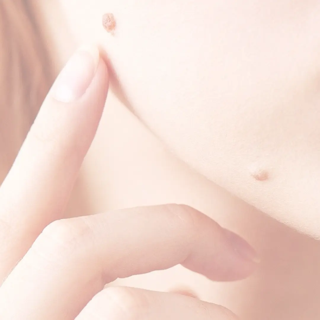 Traitement des grains de beauté au sein du CLME