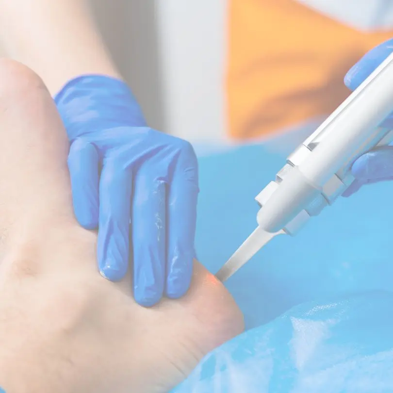 Traitement des verrues au laser au CLME