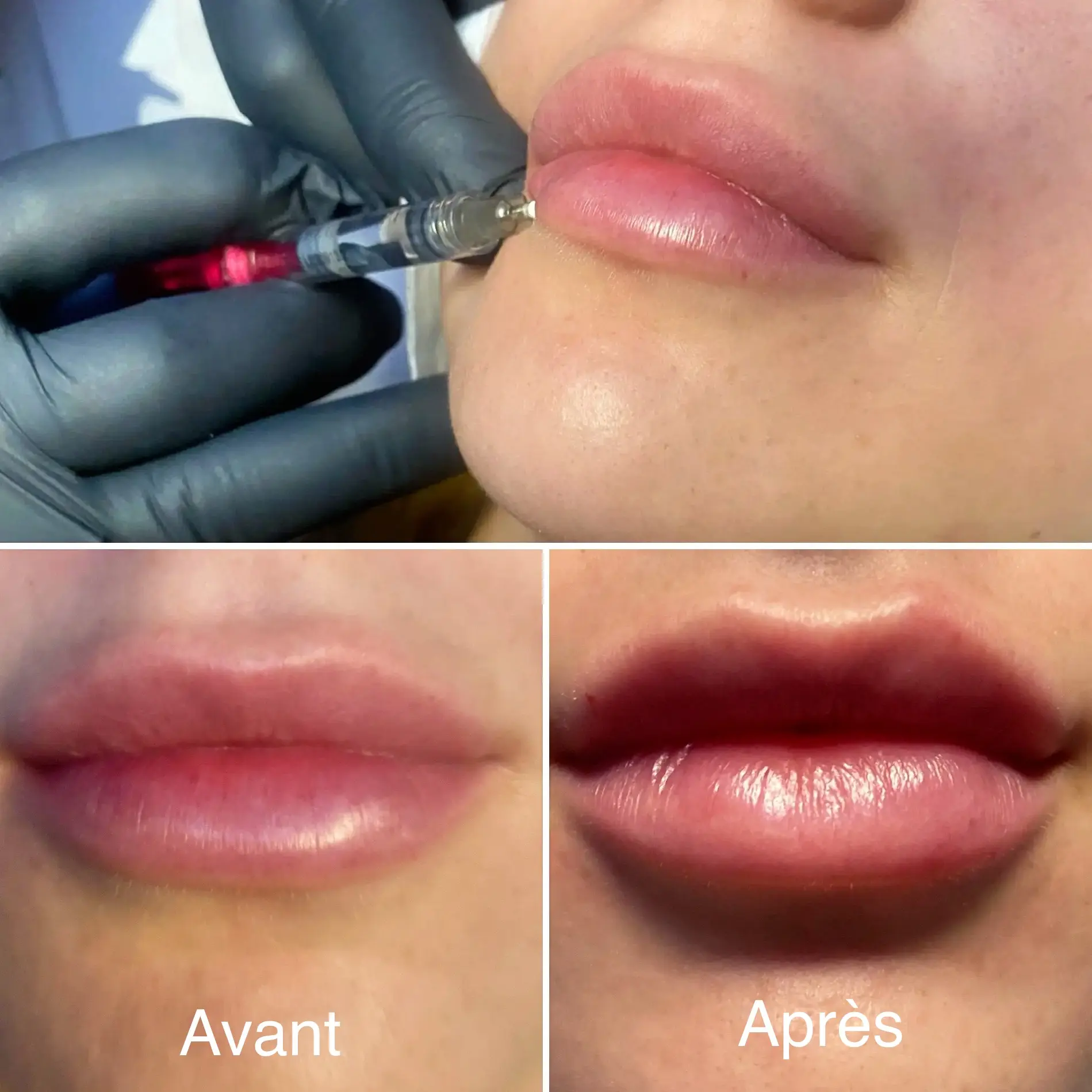 CLME : solutions médicales avec l'acide hyaluronique pour les lèvres