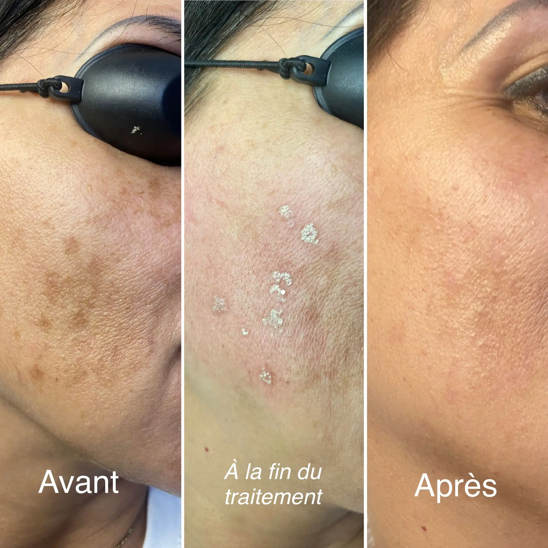 CLME : solutions médicales avec le Carbon Peel 